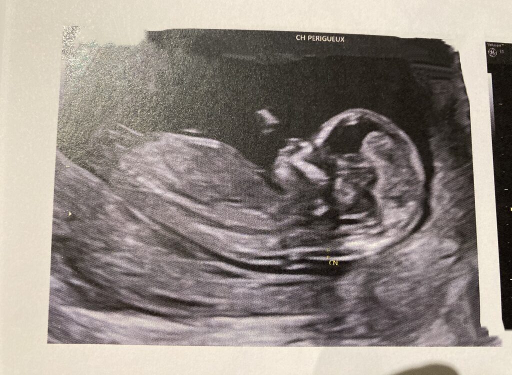 Baby scan at 13 weeks 