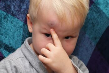 young boy pointing to bruise on his forehead