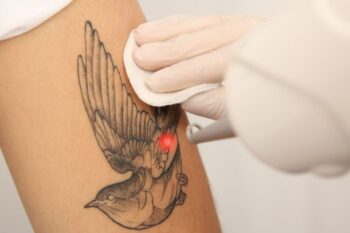 laser removing tattoo